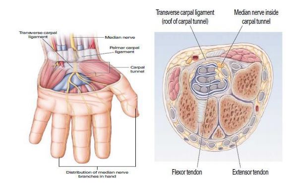 sakit di telapak tangan (carpal tunnel syndrome)
